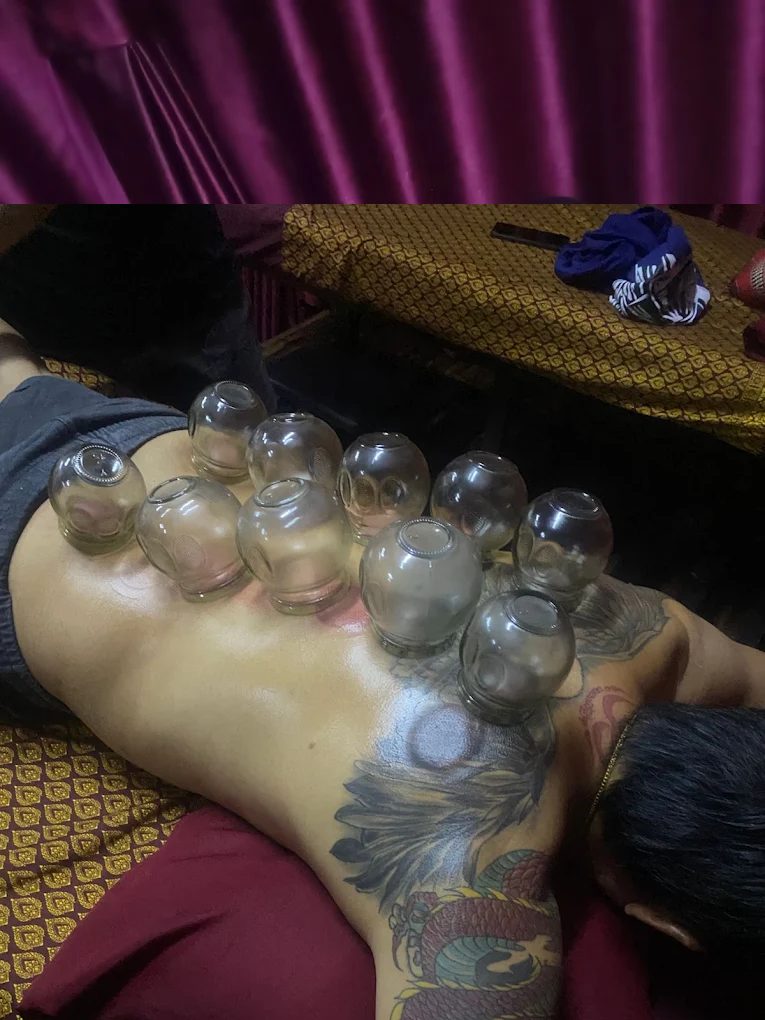 Cupping therapy treatment on client's back